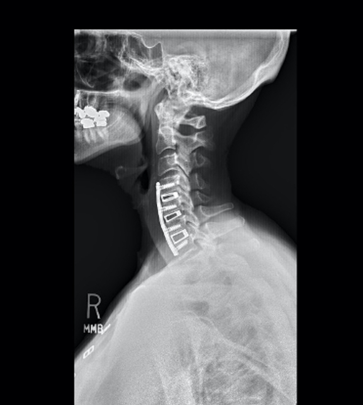 kyphosis